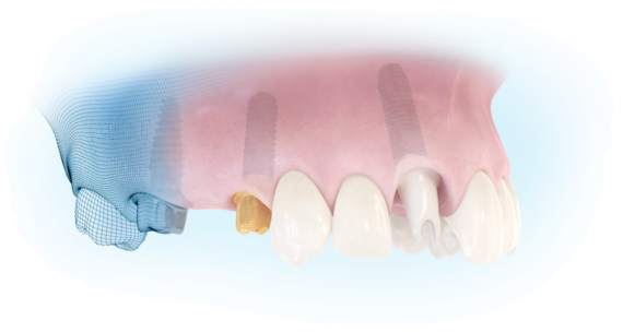 Patient-specific abutments – beyond CAD/CAM