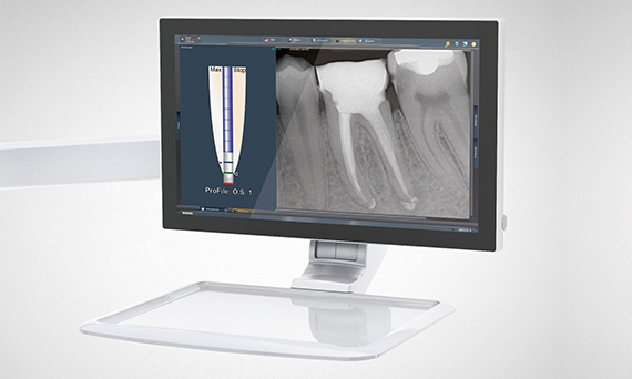 ApexLocator on the Sivision monitor of a treatment center