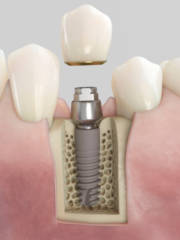 Astra Tech Implant EV