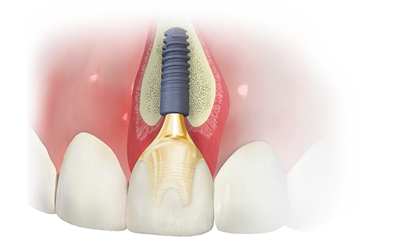 One-fits-all TissueCare connection