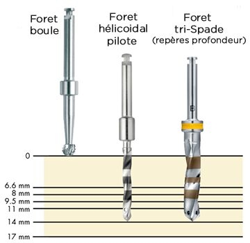 Les forets Tri-Spade Ankylos (forets hélicoïdaux)