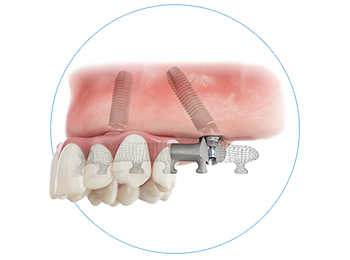 SmartFix concept with the Astra Tech Implant System EV 