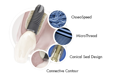 Astra Tech Implant System TX BioManagement Complex