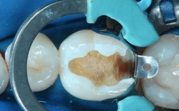 Placing Palodent  V3 Dental Matrix 