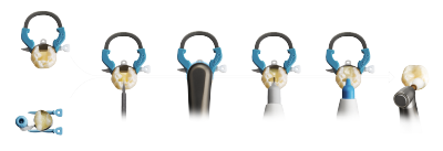 Class II Workflow Image with Palodent 360