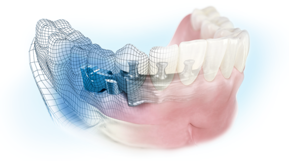 Patient-specific suprastructures beyond CAD/CAM