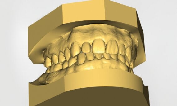 CEREC Ortho digital model