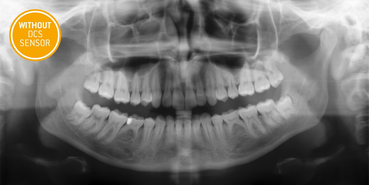 Röntgenaufnahme ohne DCS Sensor